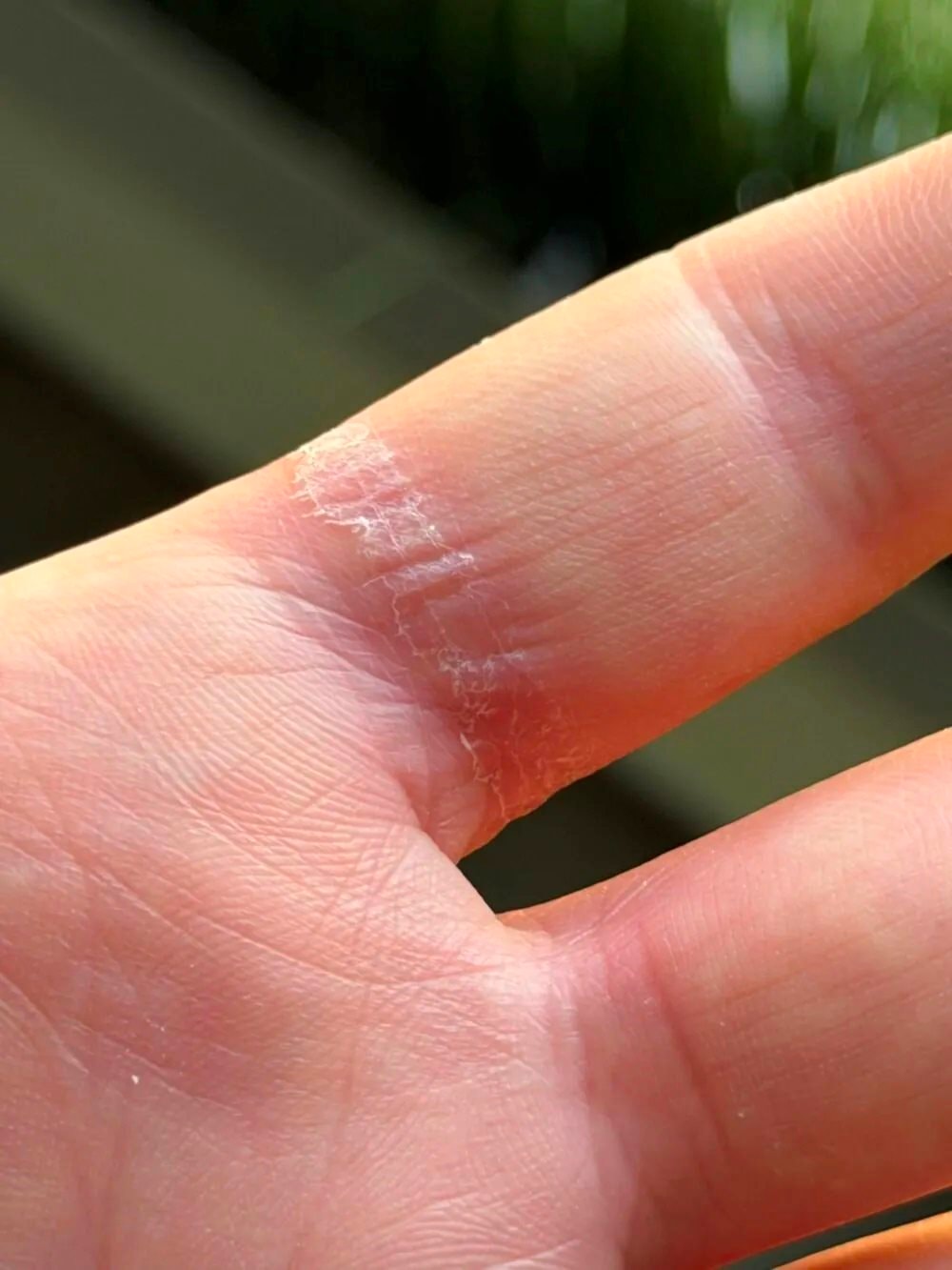 galaxy-ring-swelling-aftermath-1000w-1333h.jpg